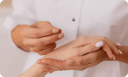 A practitioner holding a fine acupuncture needle above a patient's hand