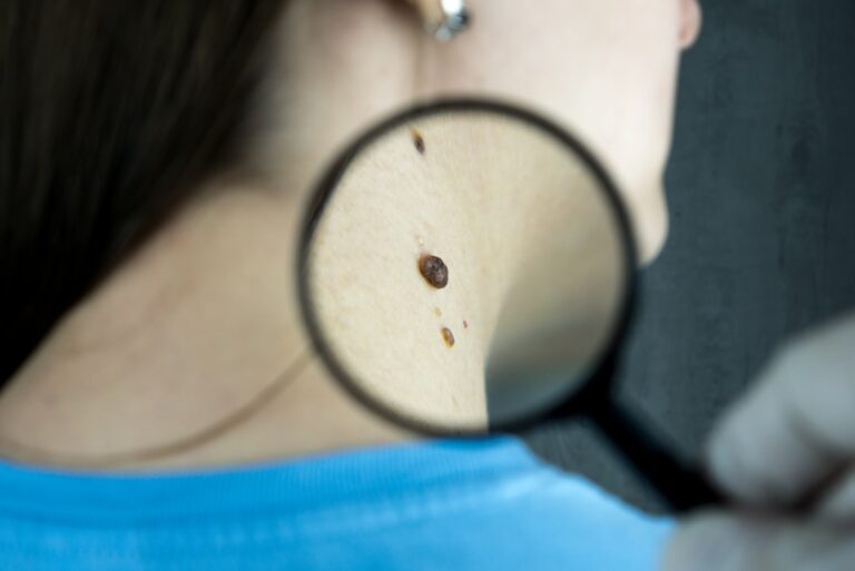 Dermatologist examining a patient's mole with a magnifying glass