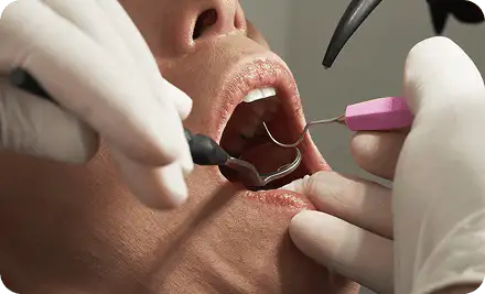 A gloved dentist using a scaler and mirror to clean a patient's teeth